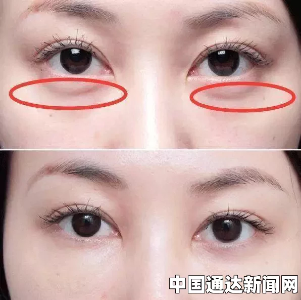 眼袋长脂肪粒是许多人都会遇到的问题，脂肪粒的形成通常是由于皮肤油脂分泌过多，导致毛孔堵塞，进而形成小颗粒。以下是一些关于如何去除眼袋上脂肪粒的方法
