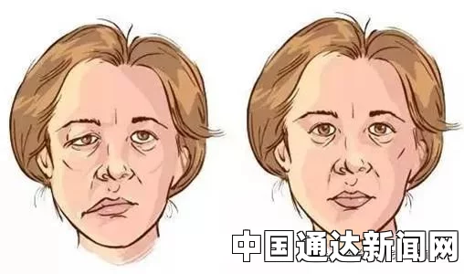 面瘫一招解决嘴歪