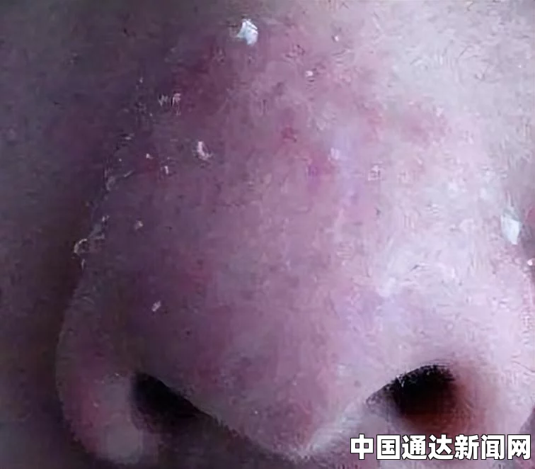 如何有效去除黑头
