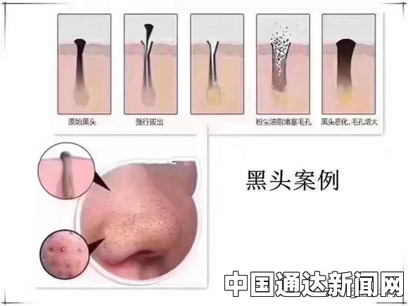 如何有效去除黑头