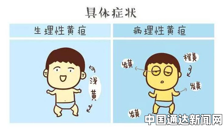 病理性黄疸