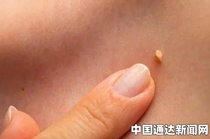 脖子上长小肉疙瘩是一个常见的皮肤问题，可能由多种原因引起。这些小肉疙瘩可能是皮肤上的良性增生，也可能是其他潜在健康问题的表现。下面将详细探讨这一现象的成因、诊断及处理方法。
