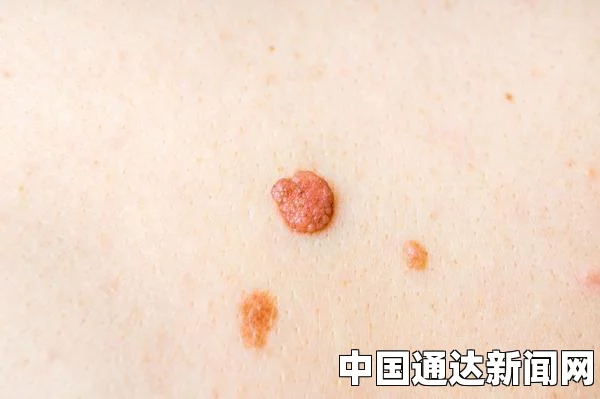 脖子上长小肉疙瘩是一个常见的皮肤问题，可能由多种原因引起。这些小肉疙瘩可能是皮肤上的良性增生，也可能是其他潜在健康问题的表现。下面将详细探讨这一现象的成因、诊断及处理方法。