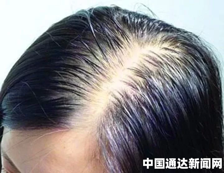 脱发怎么办？