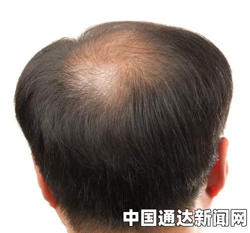 脱发怎么办？