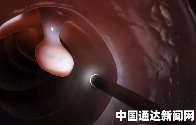肠镜检查，为何并非首选，但有时却为必要之选？
