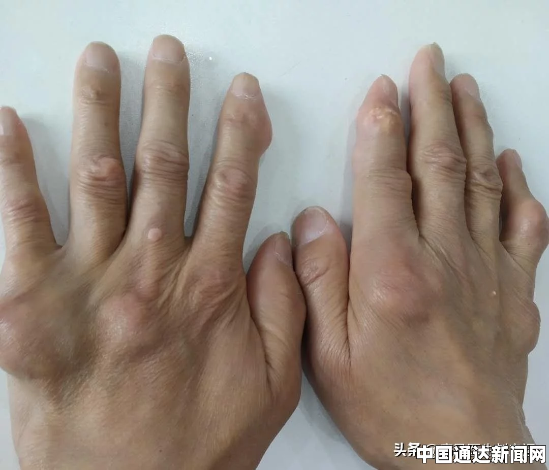 痛风是一种由于高尿酸血症引起的代谢性疾病，常常表现为关节红肿、热痛等症状。痛风发作时，消肿止痛是患者最为关心的问题。下面将介绍一些痛风消肿止痛最快的方法。